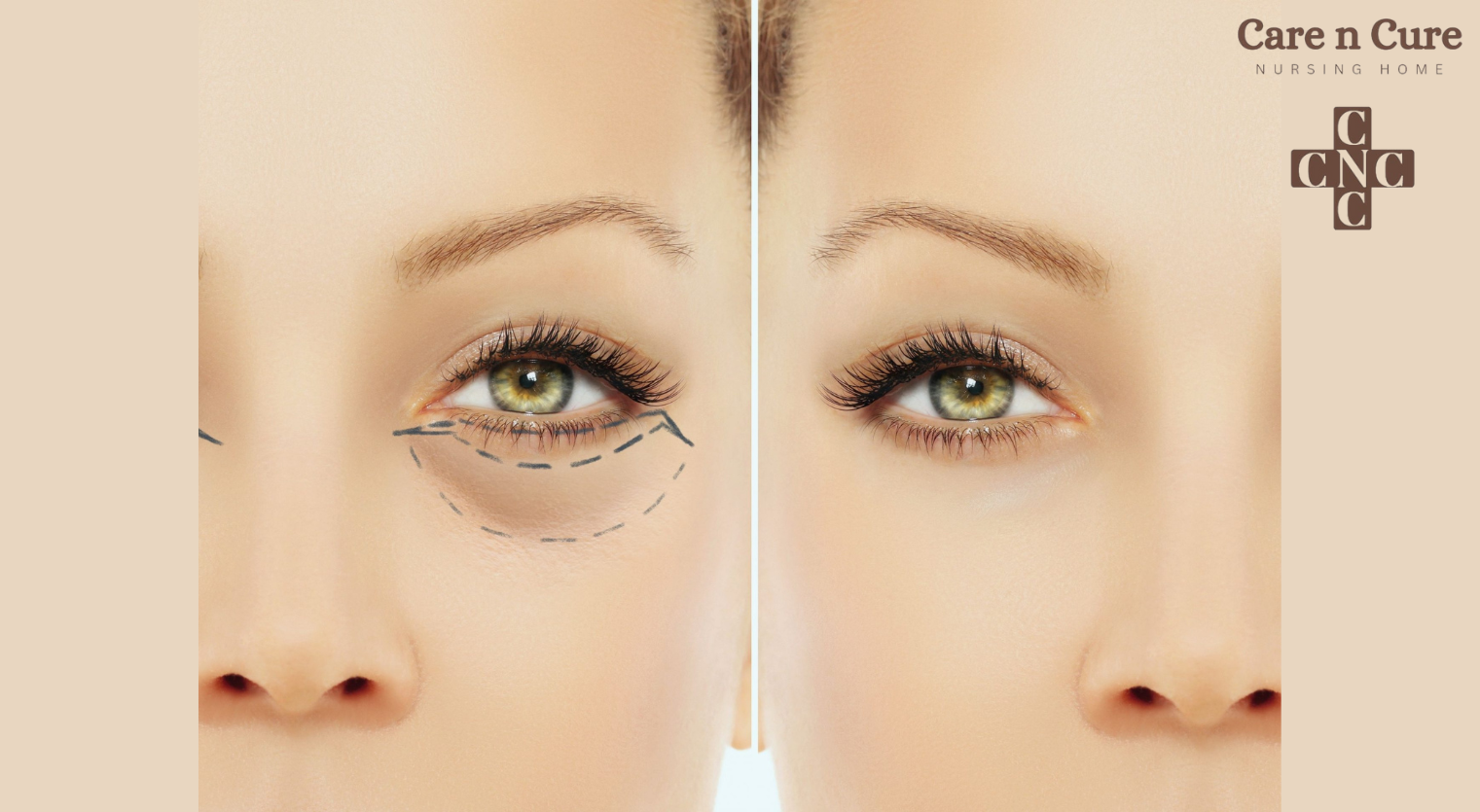 Blepharoplasty Surgery in Jammu And Kashmir | Best Eyelid Surgery Doctors In Jammu