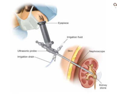 How Long Does a PCNL Take, Is PCNL a Major Surgery?