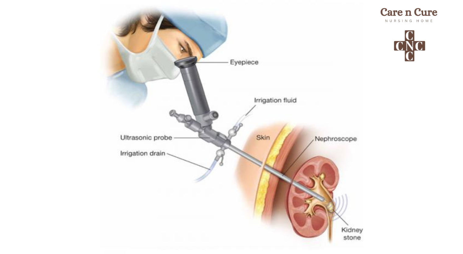 How Long Does a PCNL Take, Is PCNL a Major Surgery?