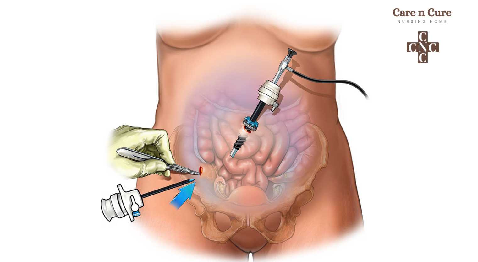 Discover Laparoscopic Surgery Hospital in Jammu-(careNcure Nursing Home Hospital).