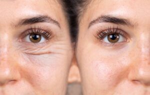 Blepharoplasty Surgery in Jammu And Kashmir | Best Eyelid Surgery Doctors In Jammu