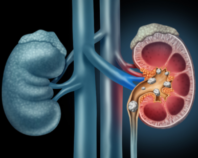 How to Recognize Kidney Stones: Signs to detect Kidney Stones - CareNCure Nursing Home Hospital