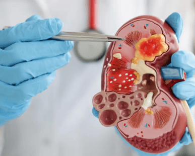 Kidney Stone Surgery or Treatment Hospital in Jammu - CareNCure Nursing Home Hospital